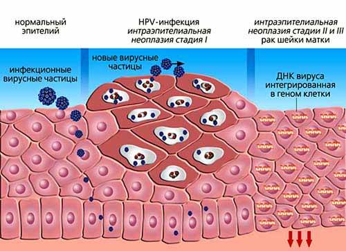 Вирус папилломы человека у женщин